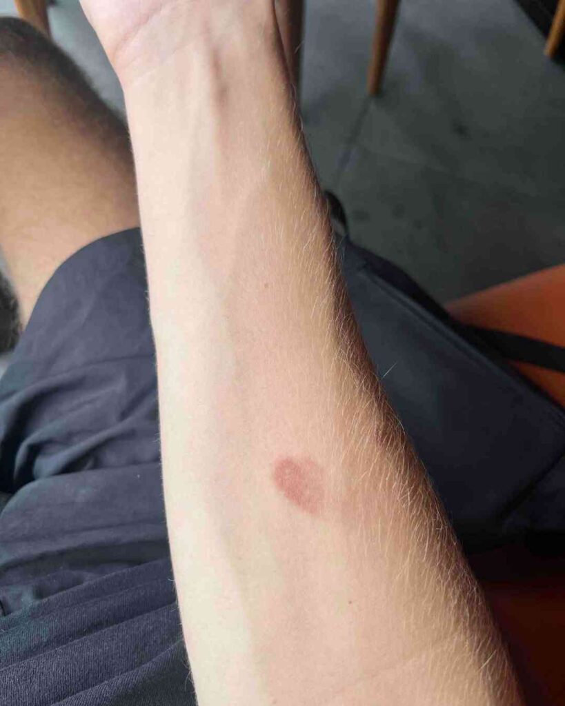 hautausschlag von dengue fieber in indonesien